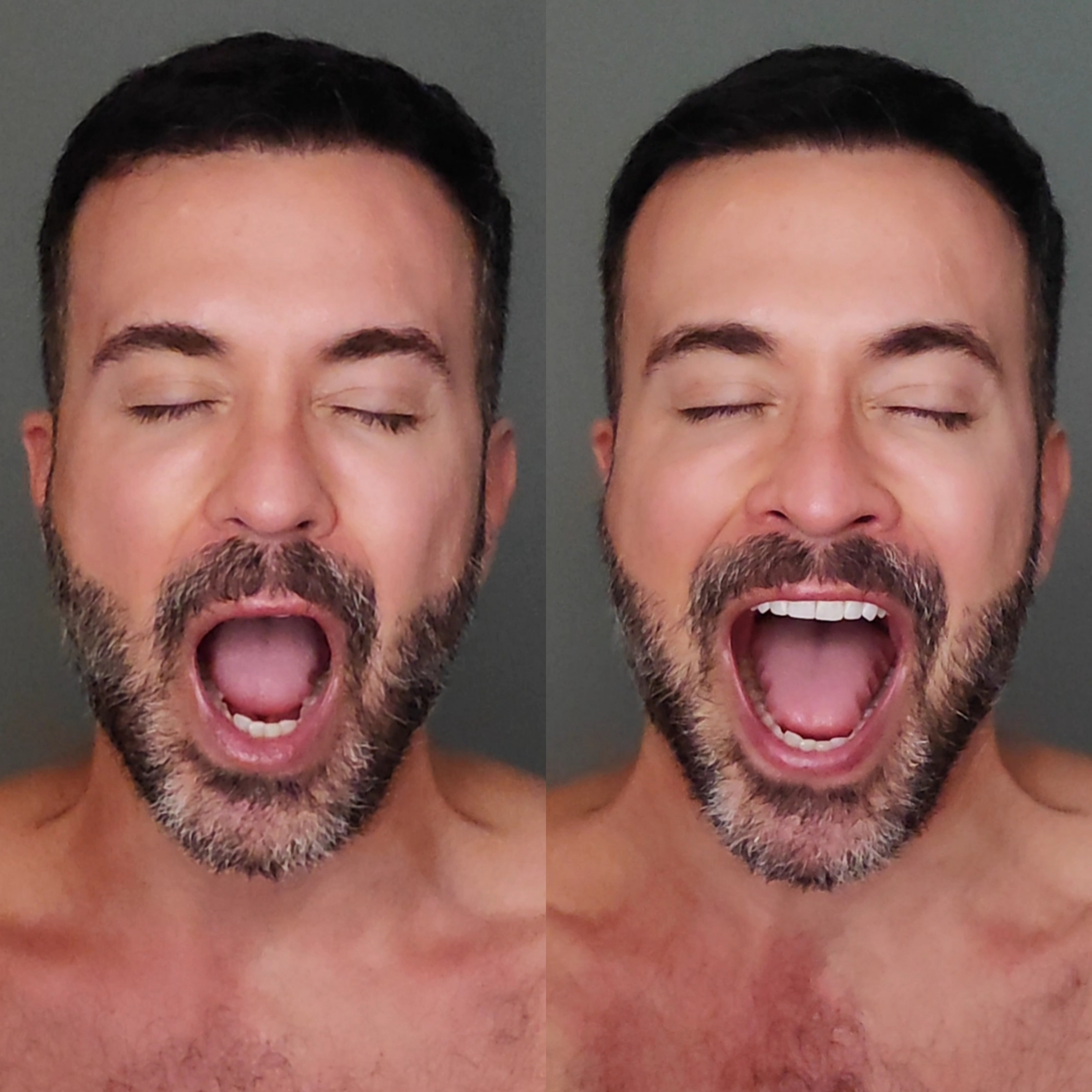 Resultado antes e depois do Método Bruxismo Zero